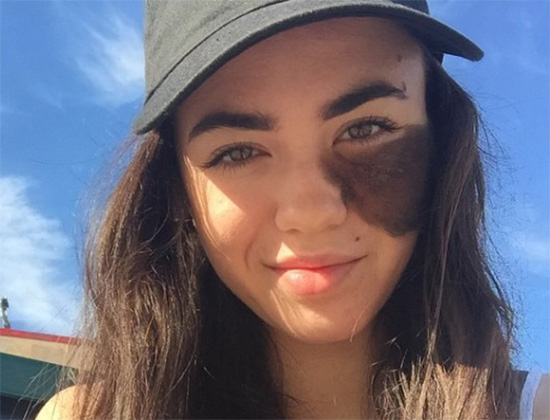 dancer-with-face-birthmark-cassandra-naud-2-605x605