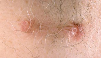 A9PWB8 Hypertrophic scar