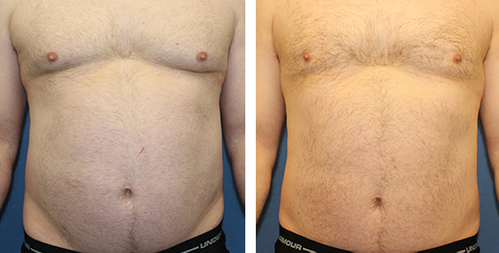 ژنیکوماستی