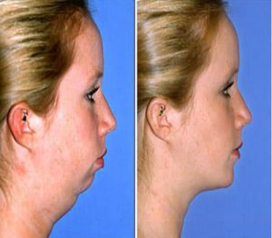 before-and-after-chin-augmentation-facial-neck-liposuction